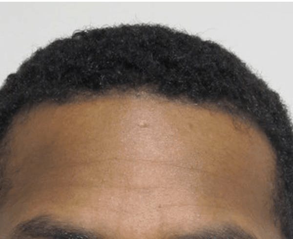 Hair Transplant Before & After Gallery - Patient 25274690 - Image 2