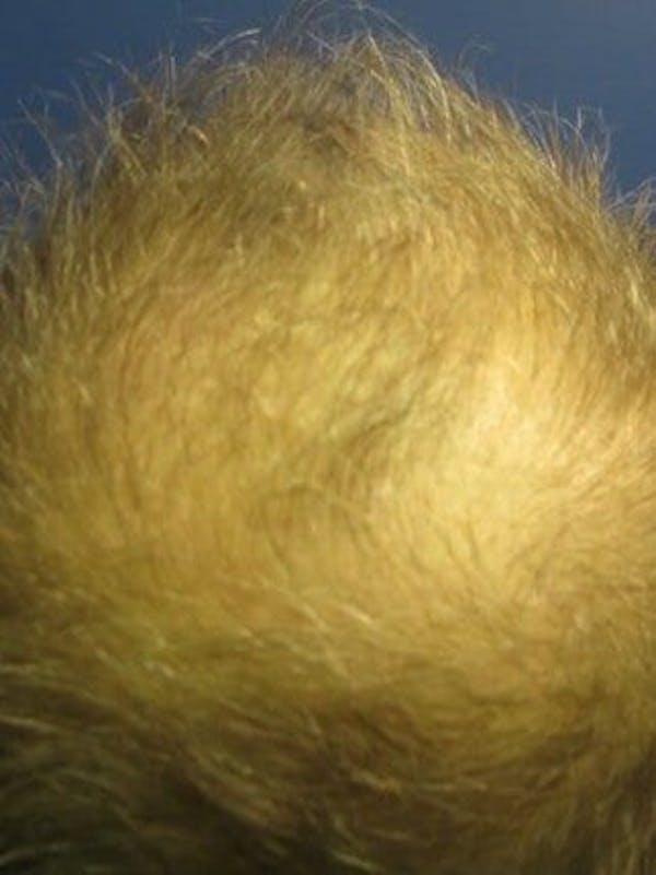 Hair Transplant Before & After Gallery - Patient 25274693 - Image 1