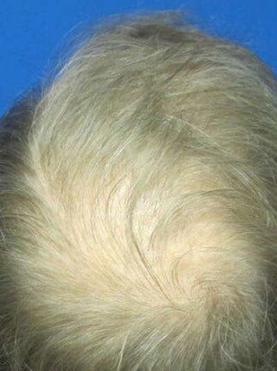 Hair Transplant Gallery - Patient 25274693 - Image 2
