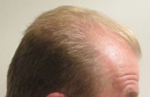 Hair Transplant Before & After Gallery - Patient 25274695 - Image 1