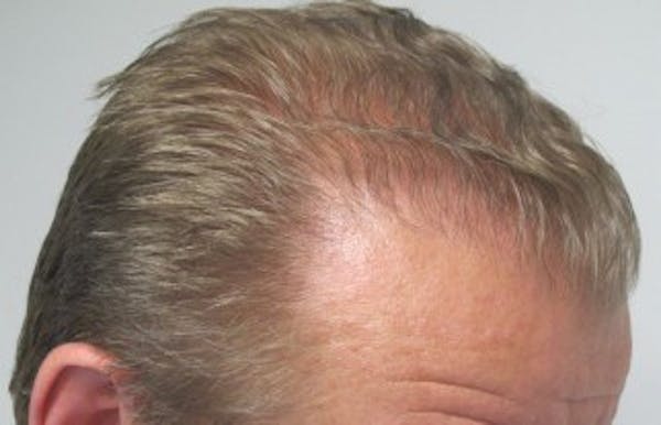 Hair Transplant Before & After Gallery - Patient 25274695 - Image 2