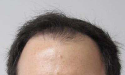 Hair Transplant Before & After Gallery - Patient 25274704 - Image 1