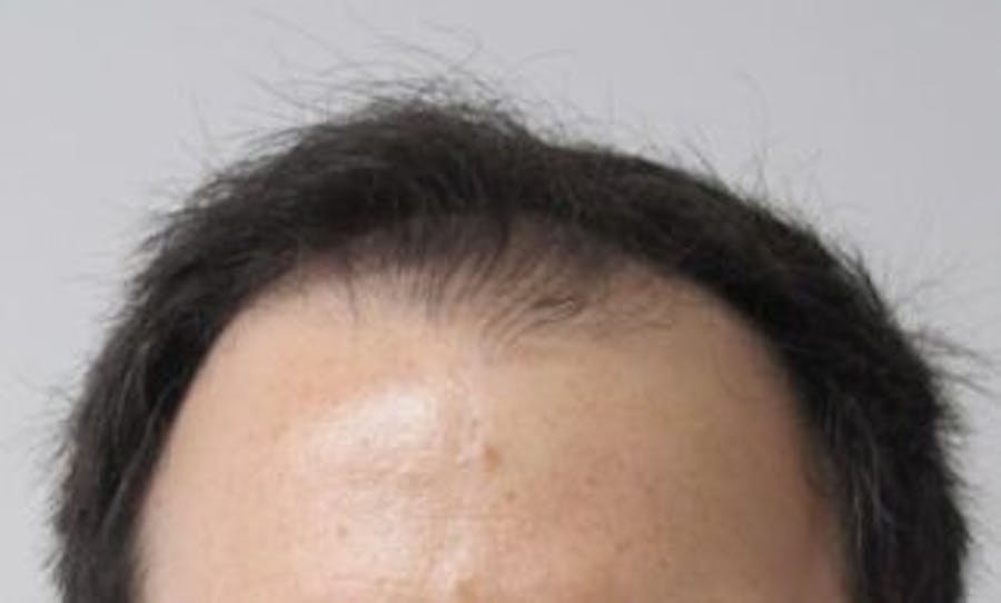 Hair Transplant Before & After Gallery - Patient 25274704 - Image 1