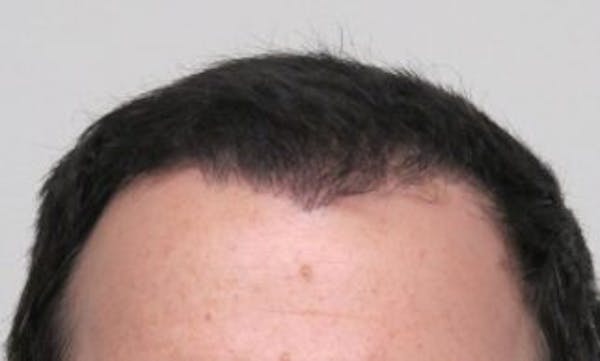 Hair Transplant Before & After Gallery - Patient 25274704 - Image 2