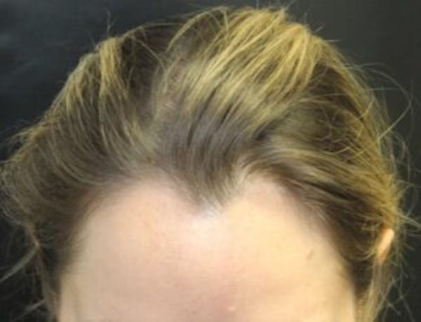 Hair Transplant Before & After Gallery - Patient 25274707 - Image 1