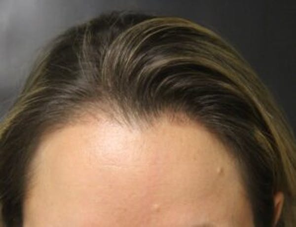 Hair Transplant Before & After Gallery - Patient 25274707 - Image 2