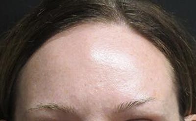 Hair Transplant Before & After Gallery - Patient 25274713 - Image 1