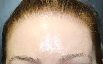 Hair Transplant Before & After Gallery - Patient 25274713 - Image 2