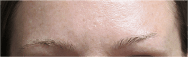 Hair Transplant Before & After Gallery - Patient 25274715 - Image 1