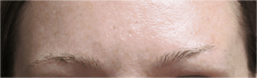 Hair Transplant Before & After Gallery - Patient 25274715 - Image 1