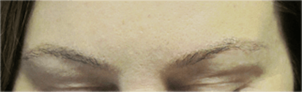 Hair Transplant Before & After Gallery - Patient 25274715 - Image 2