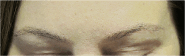 Hair Transplant Before & After Gallery - Patient 25274715 - Image 2