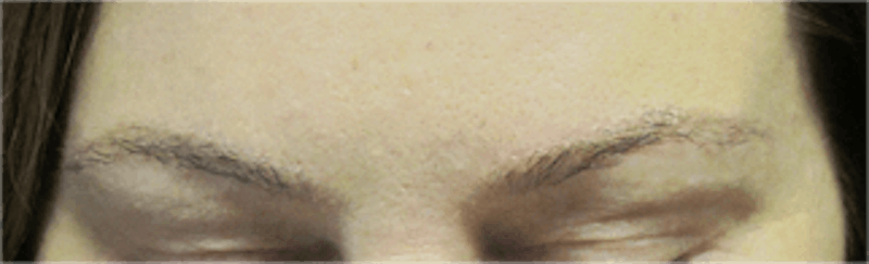 Hair Transplant Before & After Gallery - Patient 25274715 - Image 2