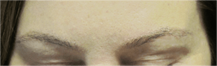 Hair Transplant Before & After Gallery - Patient 25274715 - Image 2