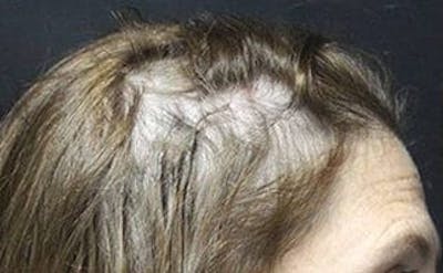 Hair Transplant Gallery - Patient 25274716 - Image 1