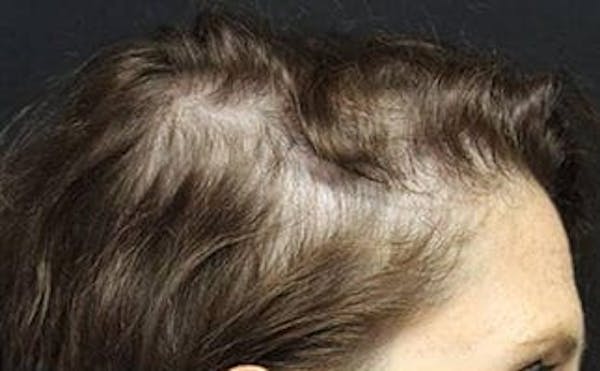 Hair Transplant Before & After Gallery - Patient 25274716 - Image 2