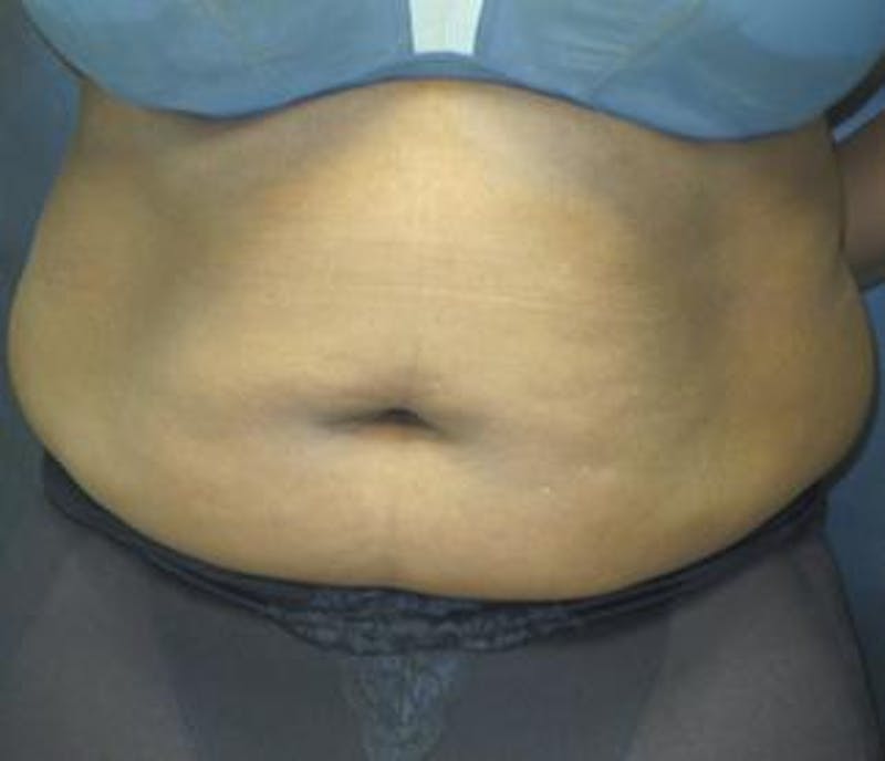 Vanquish Before & After Gallery - Patient 25274724 - Image 1