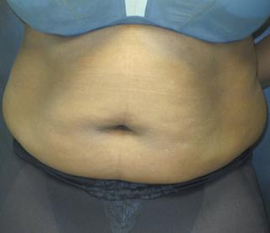 Vanquish Before & After Gallery - Patient 25274724 - Image 1