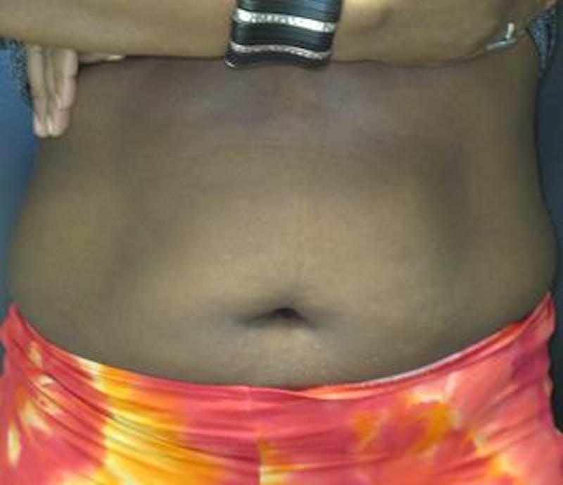 Vanquish Before & After Gallery - Patient 25274724 - Image 2