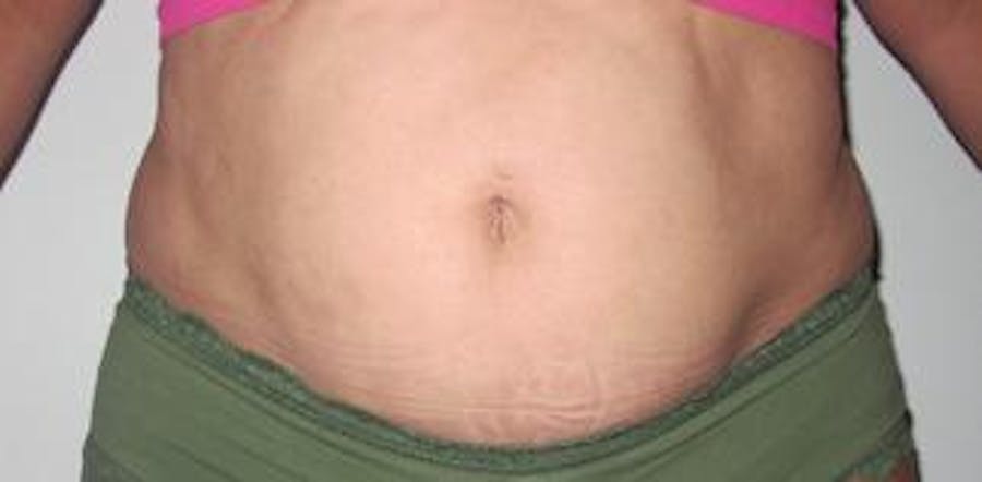 Vanquish Before & After Gallery - Patient 25274727 - Image 1