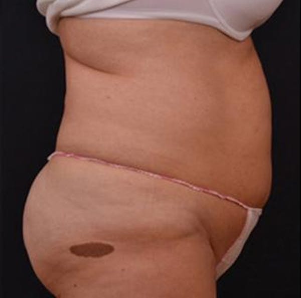 Vanquish Before & After Gallery - Patient 25274730 - Image 1