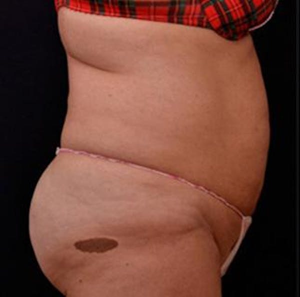 Vanquish Before & After Gallery - Patient 25274730 - Image 2