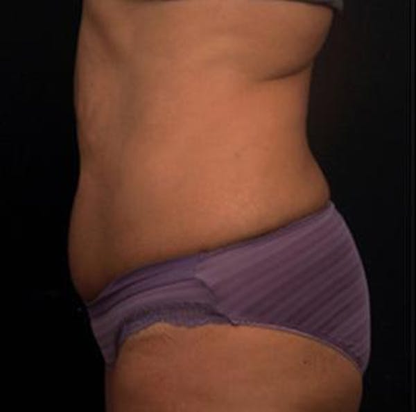 Vanquish Before & After Gallery - Patient 25274754 - Image 1