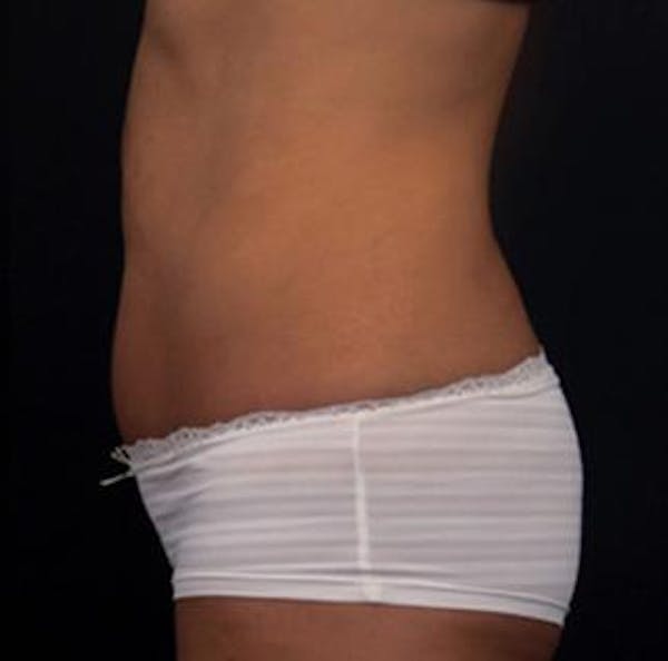 Vanquish Before & After Gallery - Patient 25274754 - Image 2