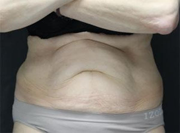 Vanquish Before & After Gallery - Patient 25274757 - Image 1