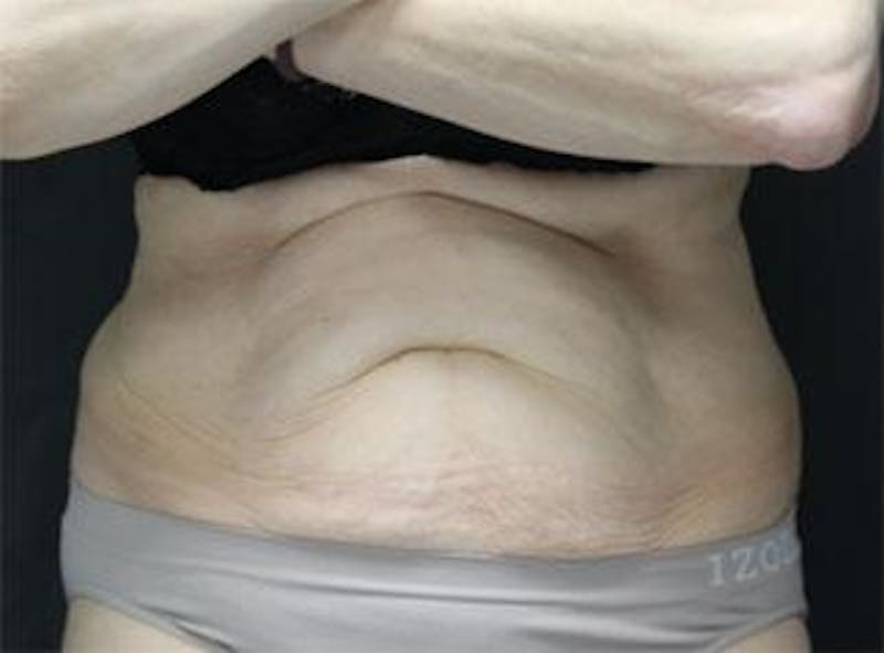 Vanquish Before & After Gallery - Patient 25274757 - Image 1
