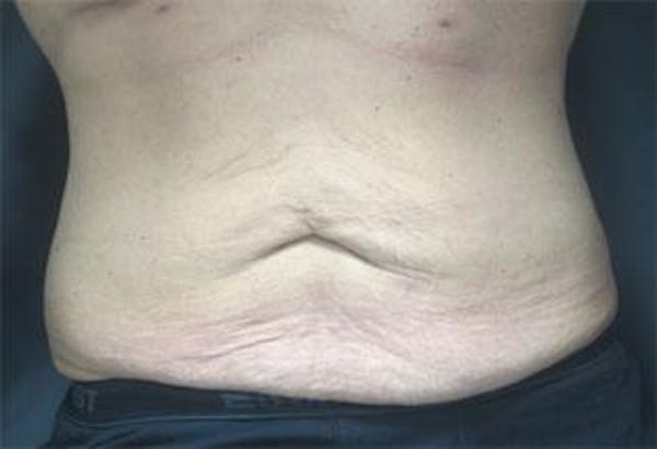 Vanquish Before & After Gallery - Patient 25274759 - Image 1