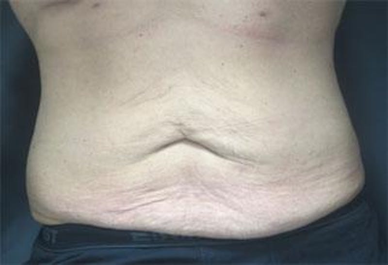 Vanquish Before & After Gallery - Patient 25274759 - Image 1