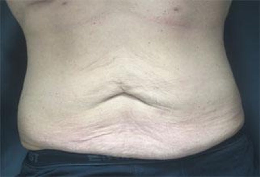 Vanquish Before & After Gallery - Patient 25274759 - Image 1