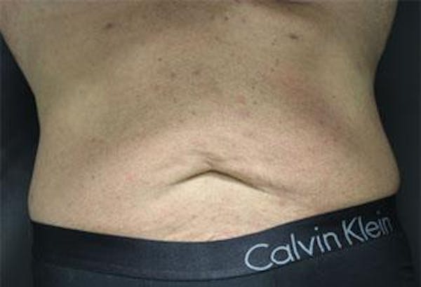 Vanquish Before & After Gallery - Patient 25274759 - Image 2
