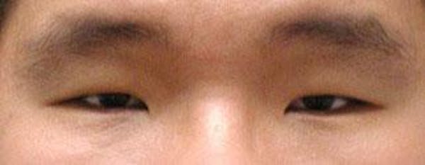 Before and After Asian Eyelid Surgery in NYC - 01