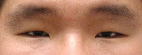Asian Eyelid Surgery Before & After Gallery - Patient 25274762 - Image 1