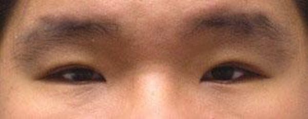 Asian Eyelid Surgery Before & After Gallery - Patient 25274762 - Image 2