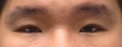 Before and After Asian Eyelid Surgery in NYC - 01