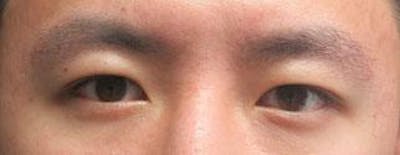 Asian Eyelid Surgery Before & After Gallery - Patient 25274765 - Image 1