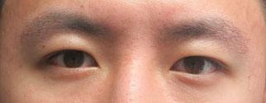 Asian Eyelid Surgery Before & After Gallery - Patient 25274765 - Image 1
