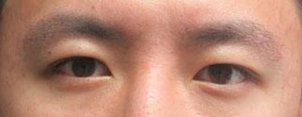 Asian Eyelid Surgery Before & After Gallery - Patient 25274765 - Image 1