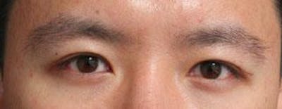 Asian Eyelid Surgery Before & After Gallery - Patient 25274765 - Image 2