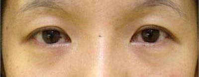 Asian Eyelid Surgery Before & After Gallery - Patient 25274768 - Image 1