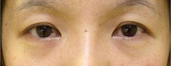 Asian Eyelid Surgery Before & After Gallery - Patient 25274768 - Image 1