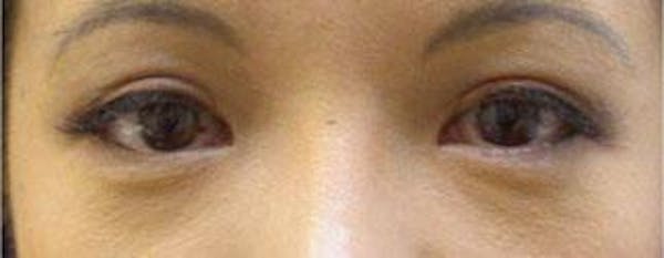 Before and After Asian Eyelid Surgery in NYC - 03