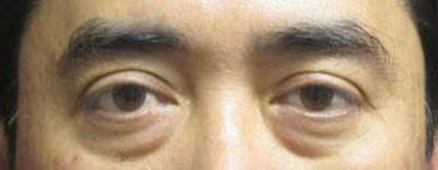 Asian Eyelid Surgery Before & After Gallery - Patient 25274769 - Image 1