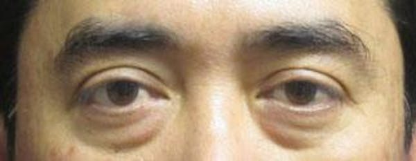 Asian Eyelid Surgery Before & After Gallery - Patient 25274769 - Image 1