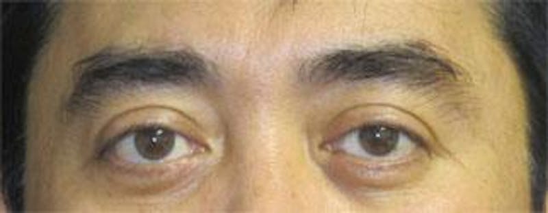 Asian Eyelid Surgery Before & After Gallery - Patient 25274769 - Image 2
