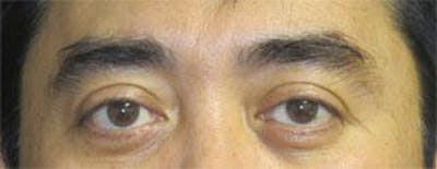 Asian Eyelid Surgery Before & After Gallery - Patient 25274769 - Image 2
