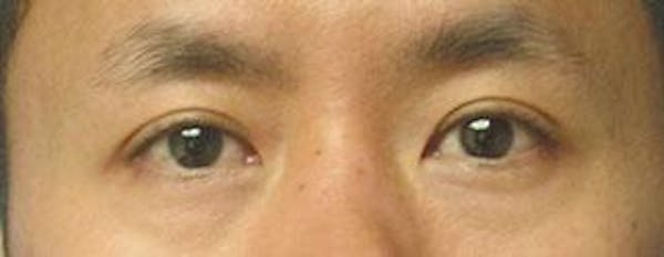 Asian Eyelid Surgery Before & After Gallery - Patient 25274770 - Image 1